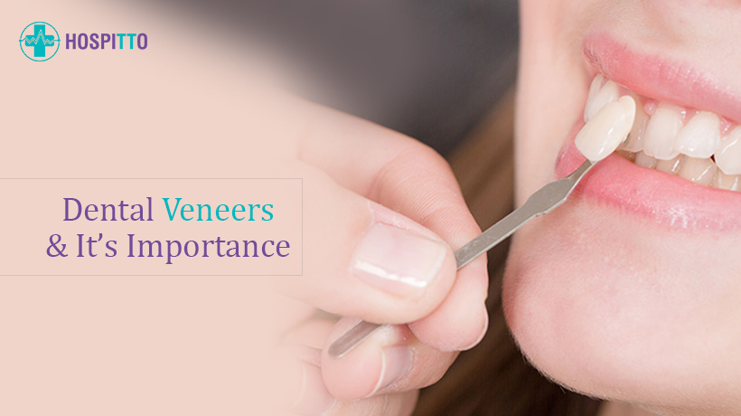 Importance of Dental Veneers